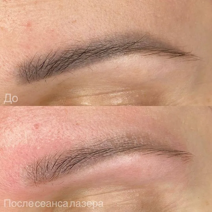 Лазерное удаление перманента бровей: до и после сеанса